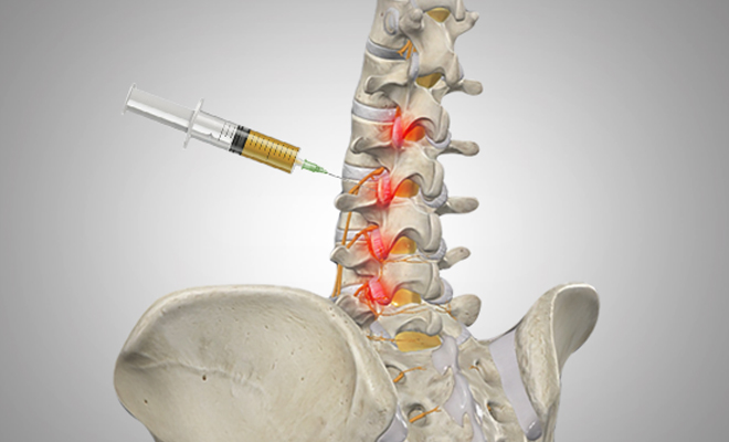PRP injections for Back Pain, Arthritis Back Pain Treated with PRP, Back Pain Treatment, Naples Back Pain Treatment, PRP for Back Pain, Platelet Rich Plasma for Back Pain, Arthritis Back Pain, How to Treat Arthritis Back Pain, What is Arthritis Back Pain, Can you get Arthritis in your Back?