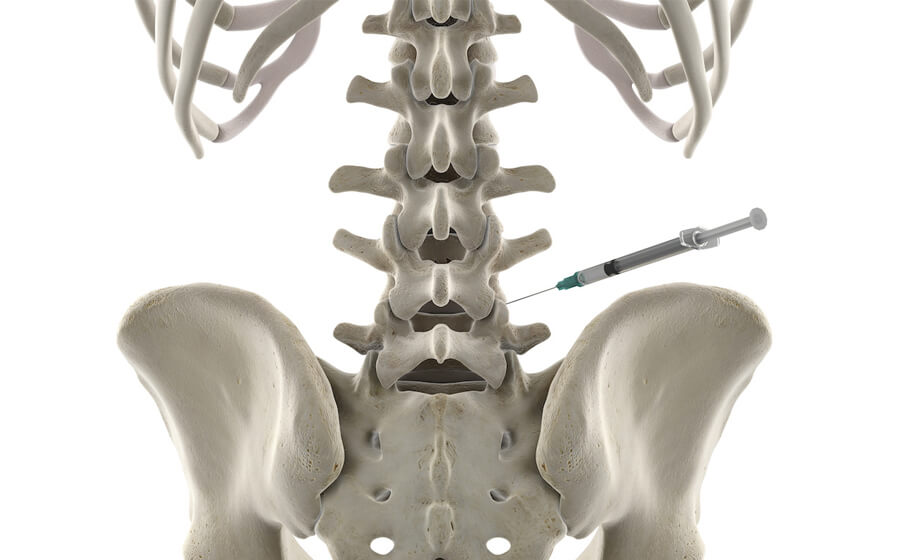 Stabalizing Spine With Prolotherapy Injections Estero