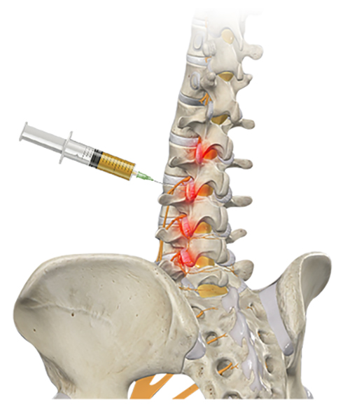 PRP injections for Back Pain, Arthritis Back Pain Treated with PRP, Back Pain Treatment, Naples Back Pain Treatment, PRP for Back Pain, Platelet Rich Plasma for Back Pain, Arthritis Back Pain, How to Treat Arthritis Back Pain, What is Arthritis Back Pain, Can you get Arthritis in your Back? Naples Florida, Estero Florida, Fort Myers Florida, Cape Coral Florida